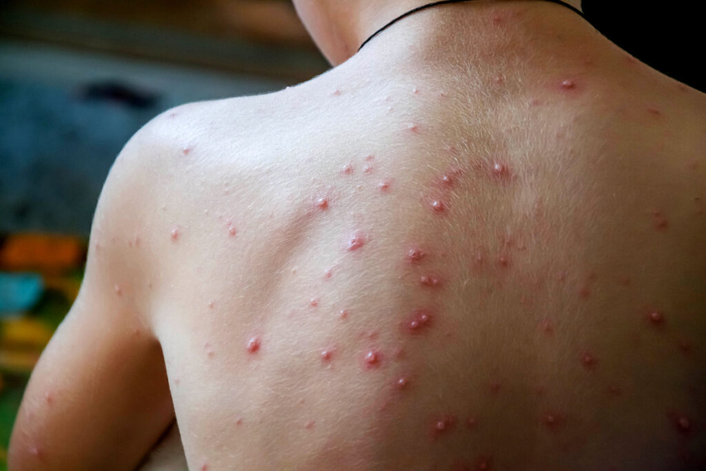 Chicken pox rash on child