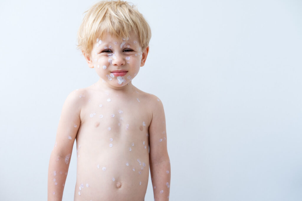 Child with chicken pox rash