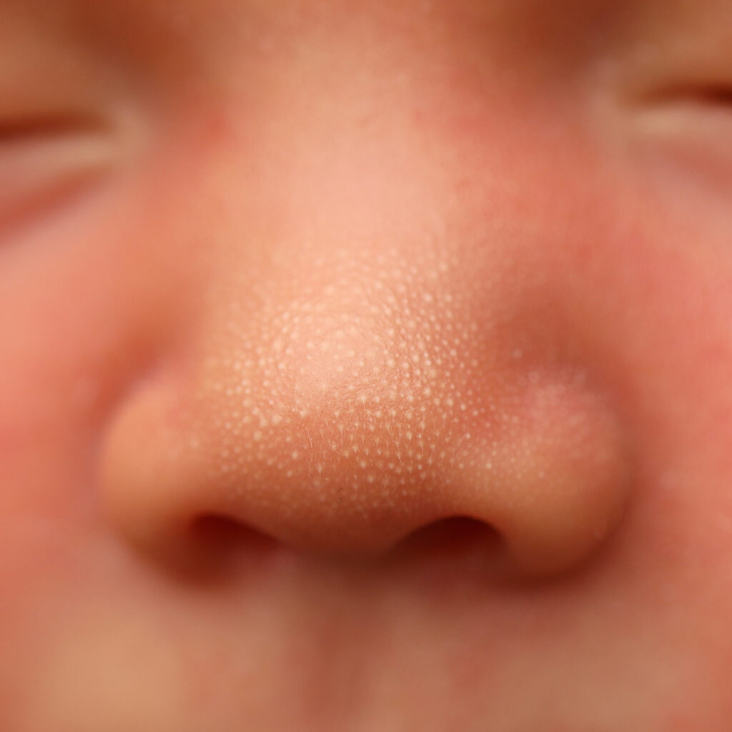 Sebaceous hyperplasia newborn skin finding