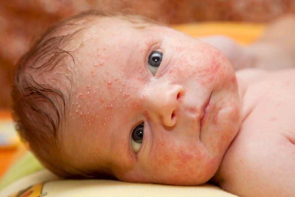 Newborn acne, newborn skin finding