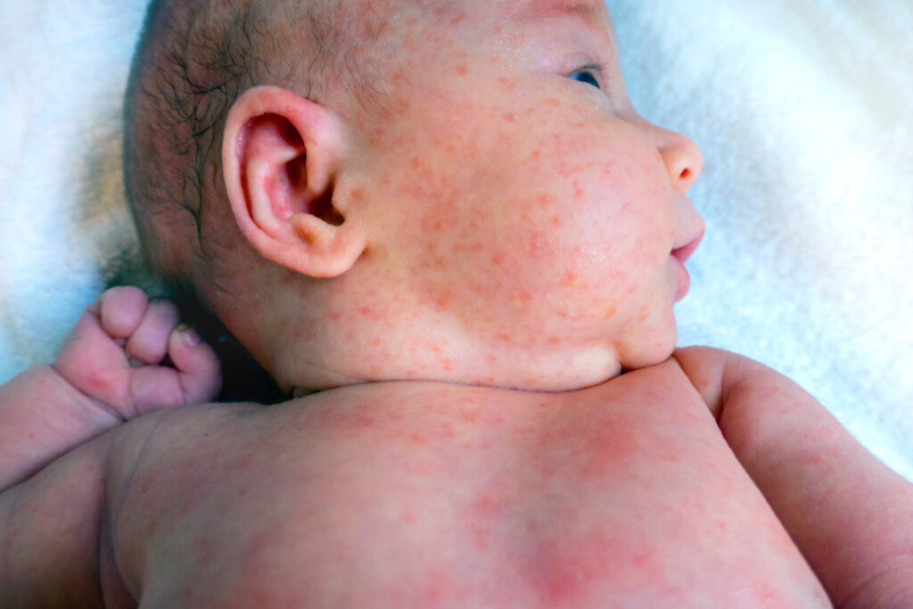 Heat rash, miliaria, newborn skin finding